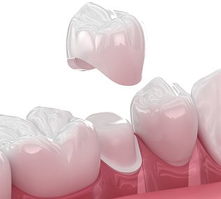 Same-day dental crown
