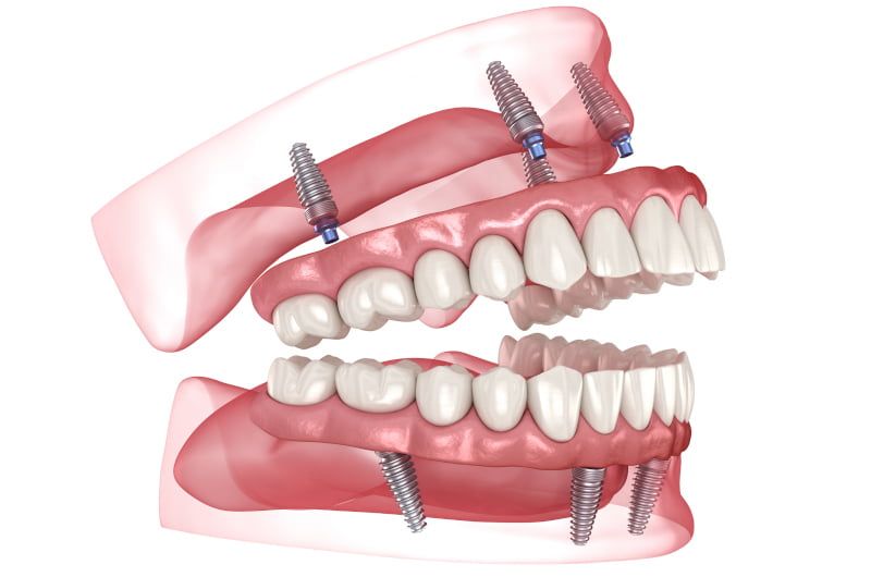 3D illustration showing a full-arch All-on-X dental implant restoration