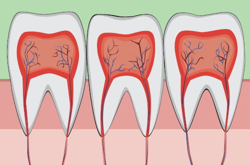 Diagram of molar tooth structure showing enamel, pulp, and nerves for root canal treatment