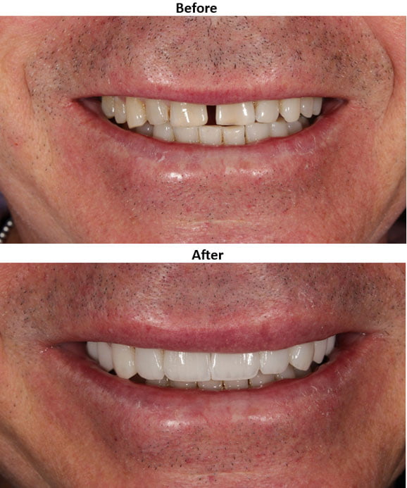 Before and after photos showing a smile transformed with dental veneers