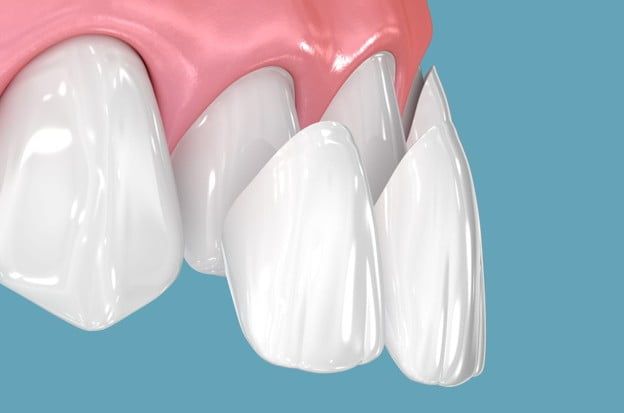 Illustration showing porcelain veneers placed over natural teeth