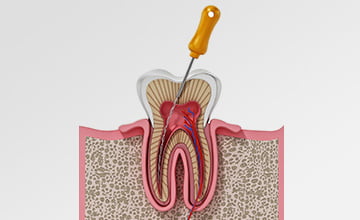 Se puede hacer endodoncia con infeccion