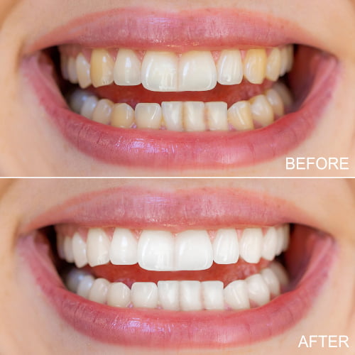 Before and after professional teeth whitening at Barrie Smile Centre