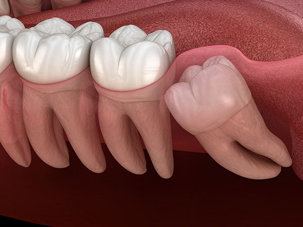 Illustration of impacted wisdom teeth growing at the back of the mouth near molars
