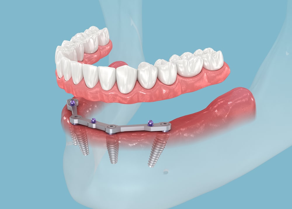 Diagram of All-on-4 dental implants showing four implants supporting a full arch prosthesis