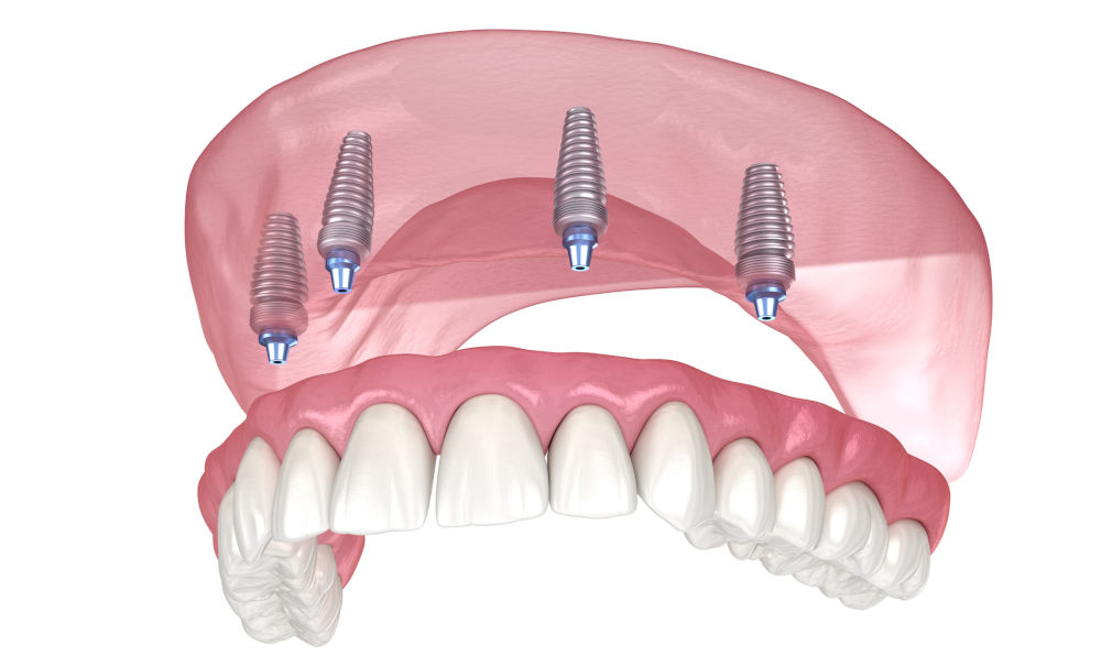 All-on-X full-arch dental implant prosthesis demonstrating same-day tooth replacement solution in Barrie