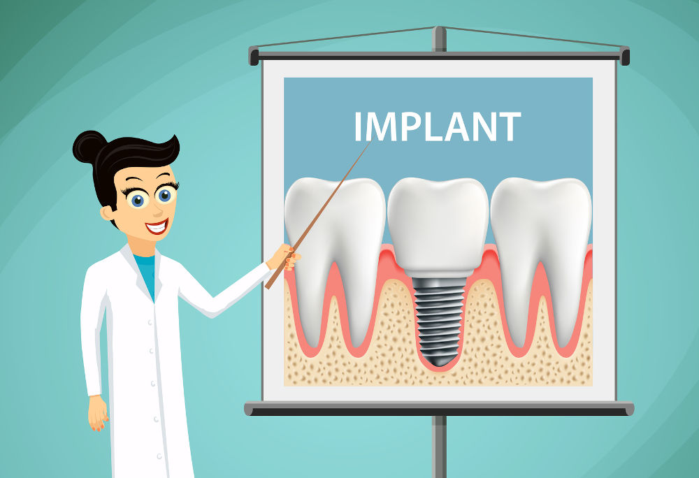 Illustration of a dentist showing a tooth poster while explaining who may be a candidate for dental implants