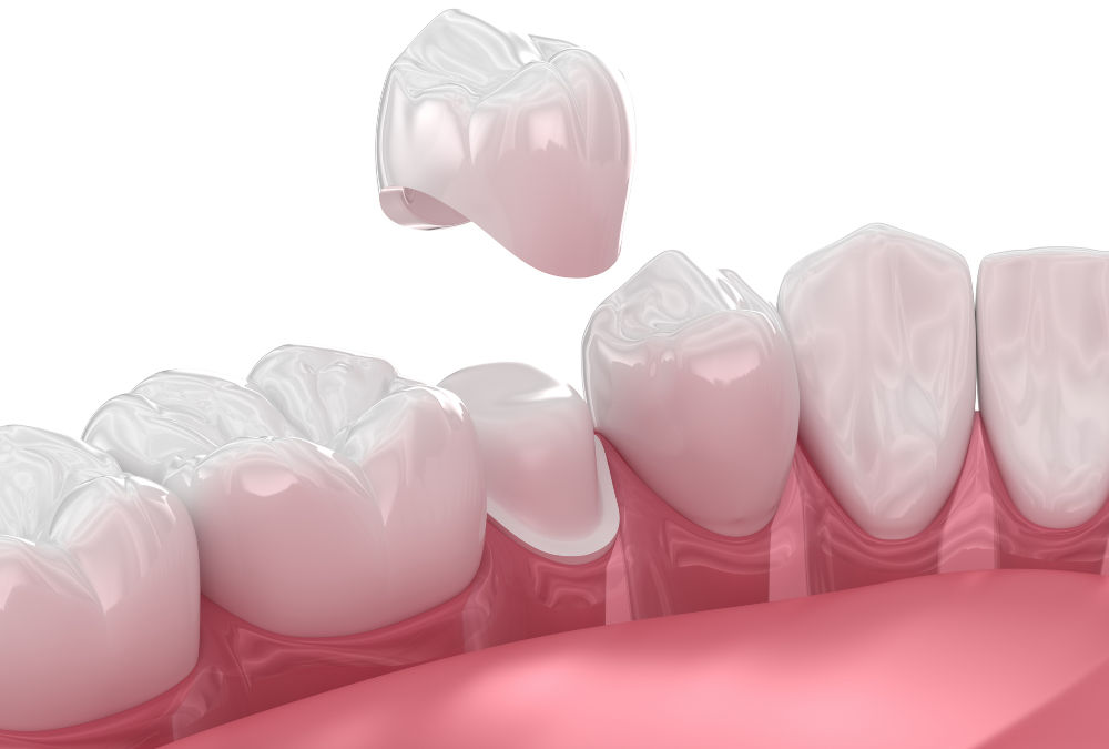 Same-day dental crown