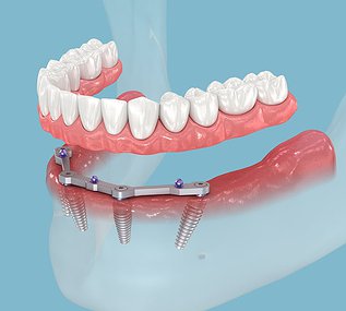 Diagram of All-on-4 dental implants showing four implants supporting a full arch prosthesis