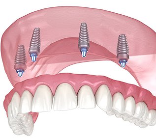 All-on-X full-arch dental implant prosthesis demonstrating same-day tooth replacement solution in Barrie