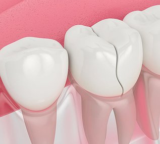 3D illustration showing a cracked tooth in the jaw, representing cracked tooth syndrome and enamel fracture