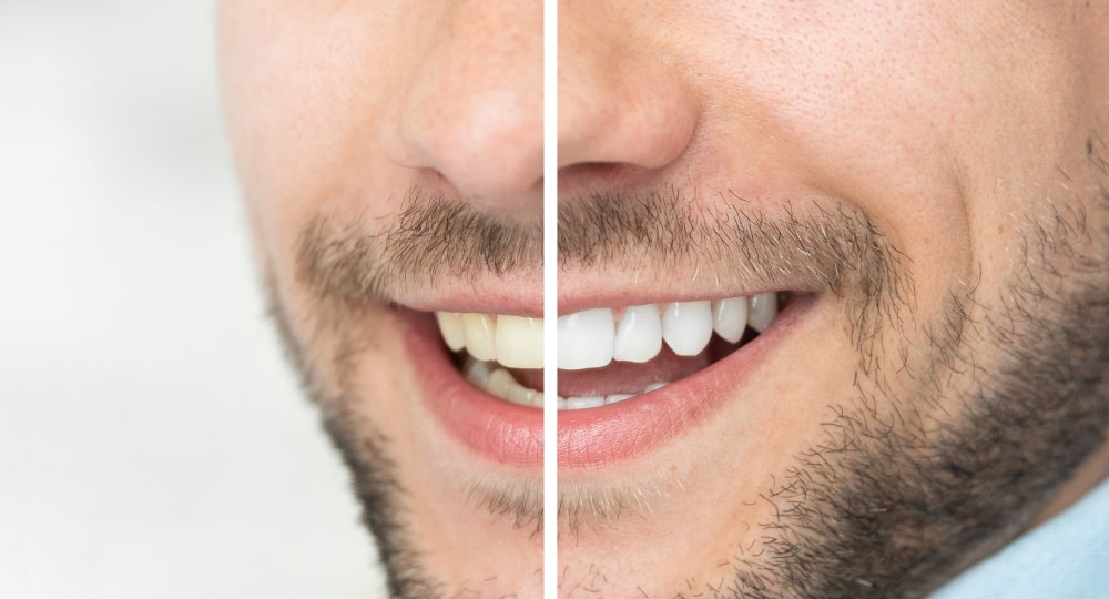 whitening before/after