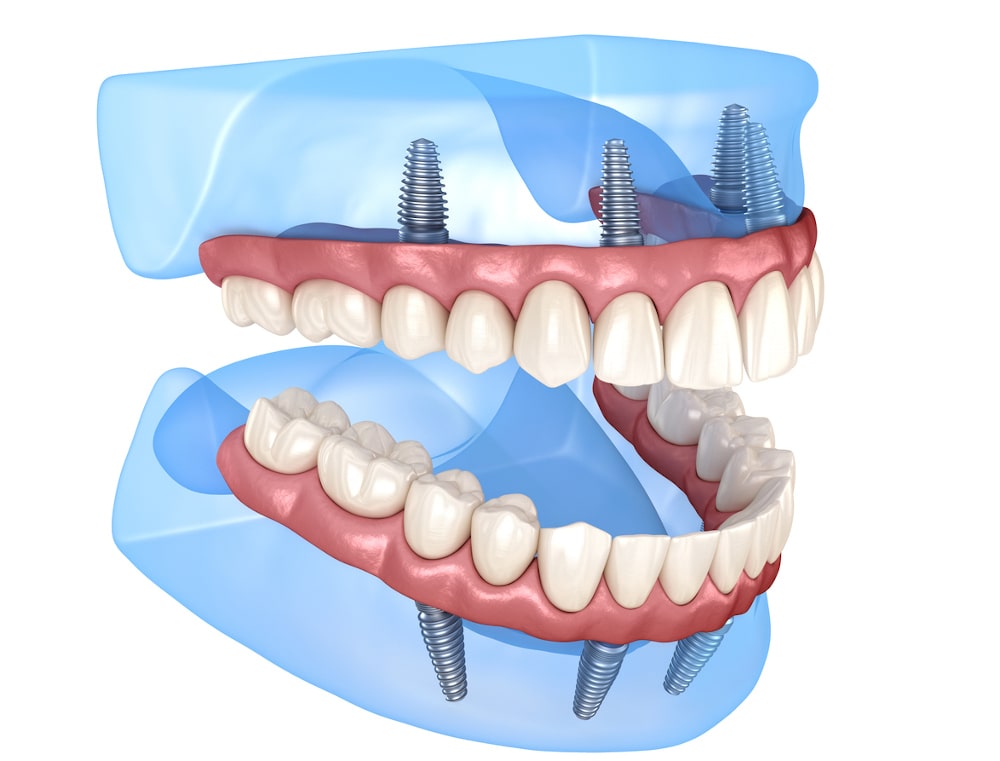 3D illustration of All-on-4 dental implants supporting upper and lower full-arch prostheses using four angled posts