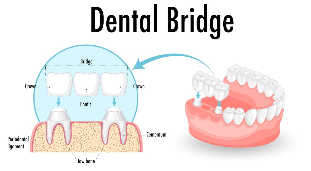 Dentist adjusting removable dentures for patient in clinic