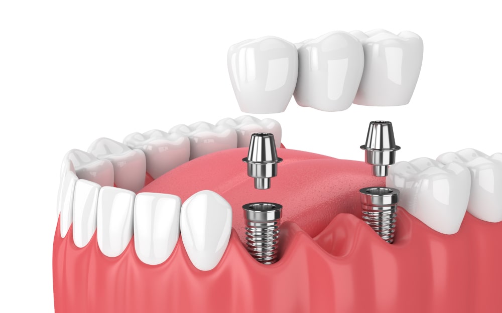 3D render of jawbone with implant-supported dental bridge