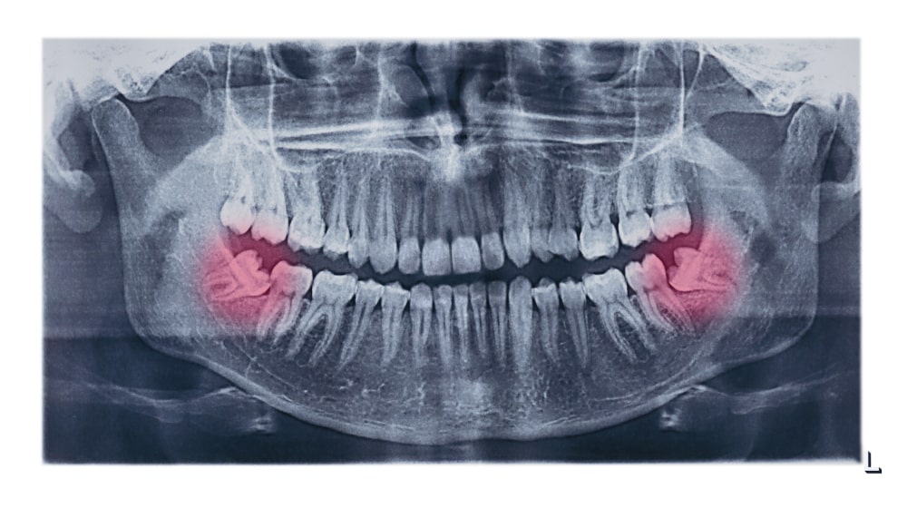 Dentist Explaining Wisdom Tooth Problem with X-ray Dentist pointing to impacted wisdom tooth on X-ray scan