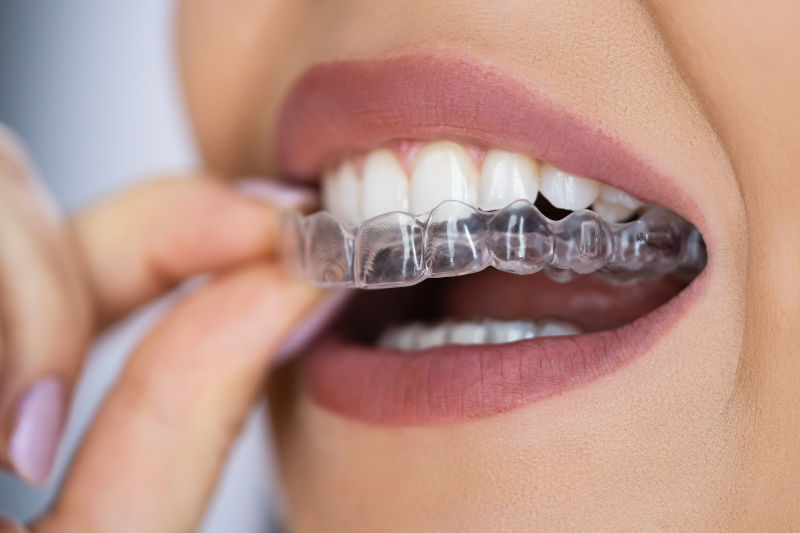 Clear aligners for adults as an invisible alternative to traditional braces