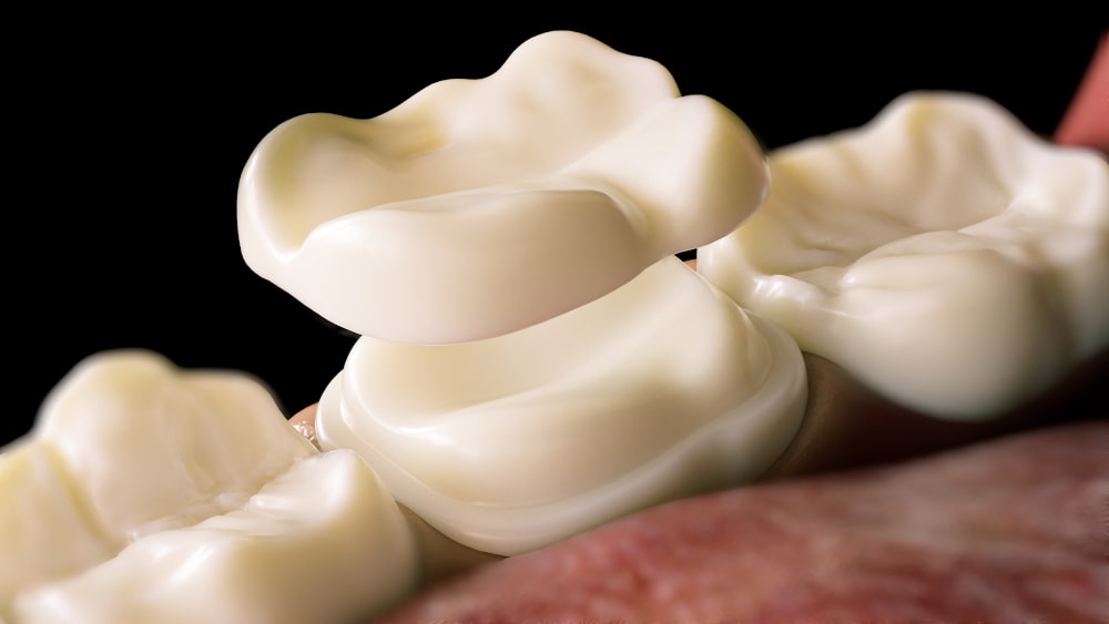 Dentist placing a same-day ceramic crown milled with the CEREC system