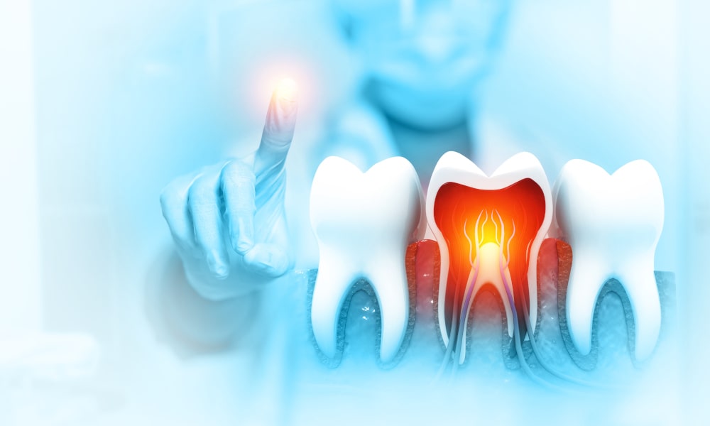 Step-by-step visual of the root canal treatment process from diagnosis to crown placement